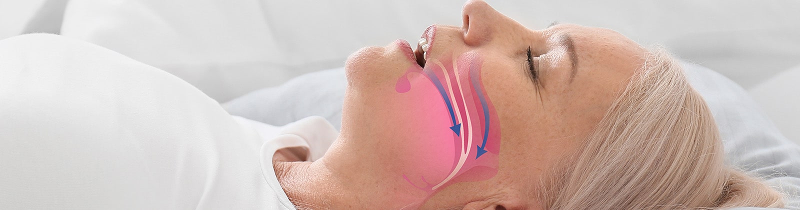 Woman sleeping on her back while mouth breathing and an overlaid diagram showing the passage of air through the nasal and oral cavities